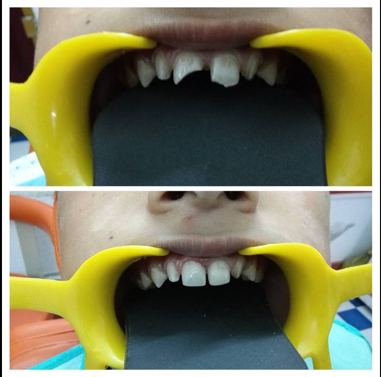 Before and after photo of a chipped front tooth repaired at Jalpaiguri Dental Clinic